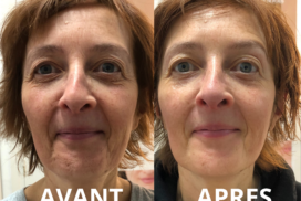 photo face après cryo et massage du visage