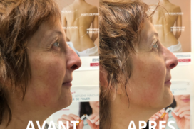 photo profil droit mix cryo massage du visage