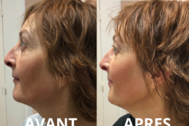 profil gauche après mix cryo massage du visage
